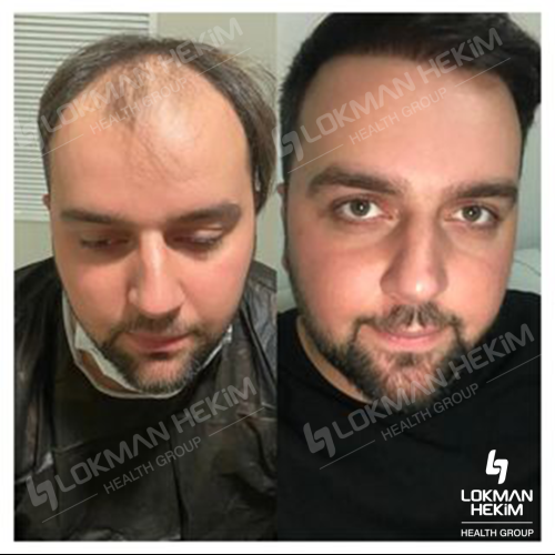 زراعة الشعر صور قبل وبعد